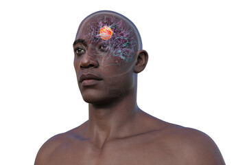 Brain tumor, 3D illustration
