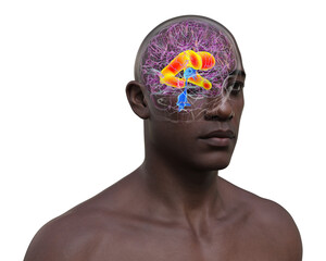 Enlarged lateral ventricles of the brain, 3D illustration