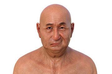 Facial palsy in a man, photorealistic 3D illustration