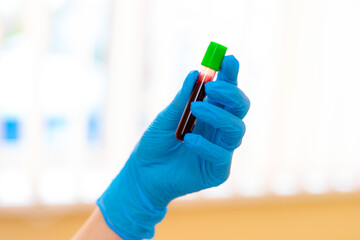 Lab tech with blood sample. A gloved hand presents a sealed blood sample with a green cap, highlighting an essential lab procedure.