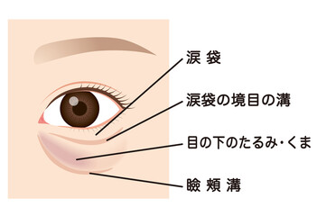 目の下のたるみ　たるんだ下まぶた