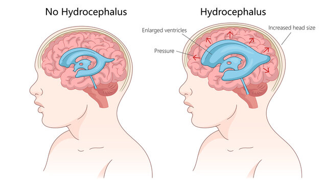 healthy brain versus a brain with hydrocephalus, enlarged ventricles, pressure, and increased head size diagram hand drawn schematic raster illustration. Medical science educational illustration