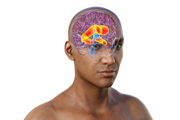 Enlarged lateral ventricles of the brain, 3D illustration