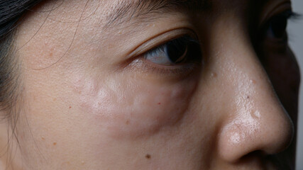 Close up of woman face with under eye swelling