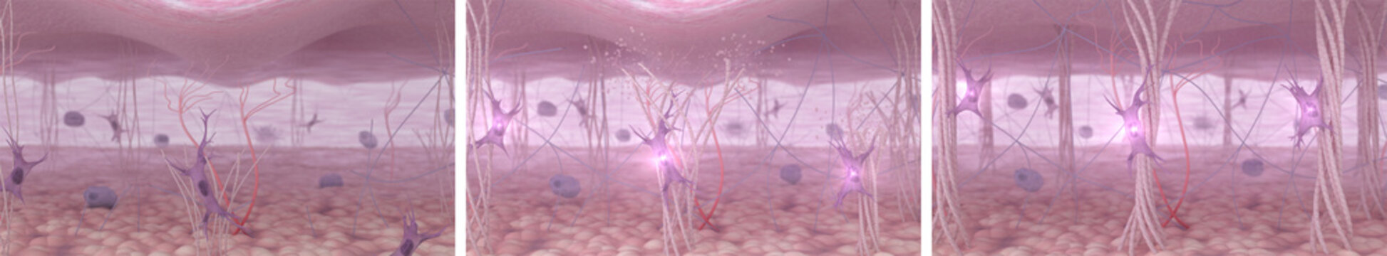 Before during and after skin rejuvenation: a cross-sectional view of collagen, elastin, and fibroblasts in aging and youthful skin. 3D Illustration of skin tissue and cellular changes
