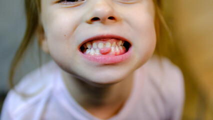 Girl shows her teeth-pathological bite, malocclusion, overbite. Pediatric dentistry and...