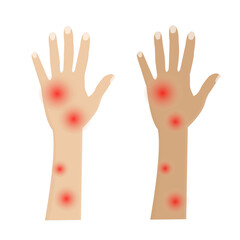 vector: red bumps on the skin of the hands due to allergies or insect bites