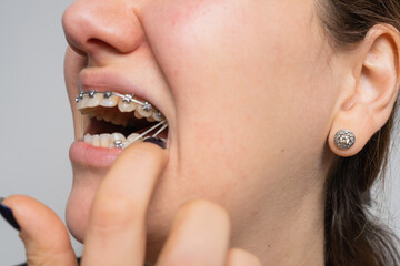 Young cheerful woman does hygiene for braces