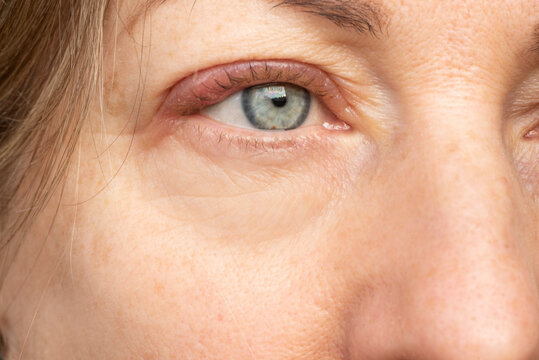 Stye or infected chalazion in a woman. Eye with inflamed upper eyelid.