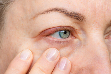 Redness and disease on the upper eyelid. Stye (chalazion). Swelling and redness on the upper...