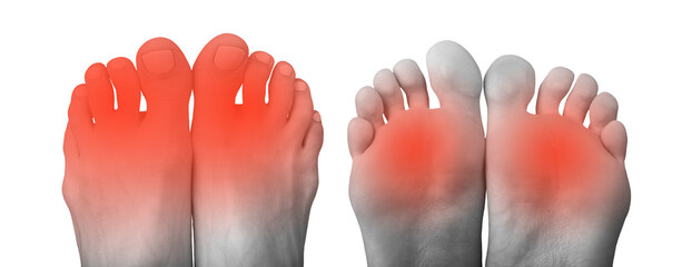 Foot pain illustration. Swollen, red feet with joint inflammation, bunion, and symptoms of plantar...