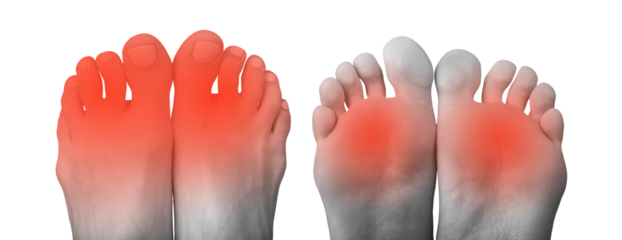 Foot pain illustration. Swollen, red feet with joint inflammation, bunion, and symptoms of plantar fasciitis. Chronic ache, diabetic neuropathy, or gout-related discomfort.