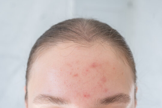 Close up of woman forehead with acne and post-acne marks. Poor skin health on T-zone. Delicate skin damaged by sunlight. Results from poor skin care.