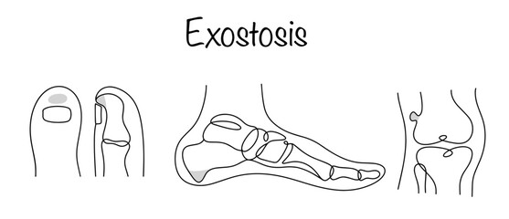 Exostosis
