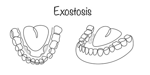 Exostosis Mouth