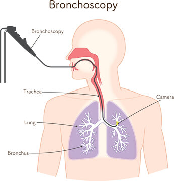 気管支鏡による肺がん検査のイラスト、Bronchoscopy