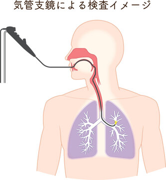 気管支鏡による肺がん検査のイラスト、Bronchoscopy
