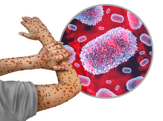 Mpox or Monkeypox Virus Outbreak as a contagious infection as blisters and leisons on the skin representing transmission of an infected person.