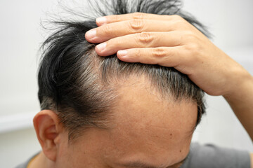 Fototapeta premium Bald in the middle head and begin no loss hair glabrous of mature Asian business smart active office man.