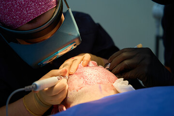 Close-up of surgeon performing hair transplant with precision tools