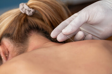 Fototapeta premium A physical therapist performs dry needling on a patients neck to alleviate muscle tension. The patient lies face down on a therapy table, receiving precise needle placement for targeted relief