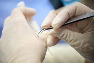 Hair Transplant Procedure Close-Up with Gloves and Tools