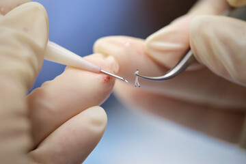 Precision in hair restoration surgery with modern techniques