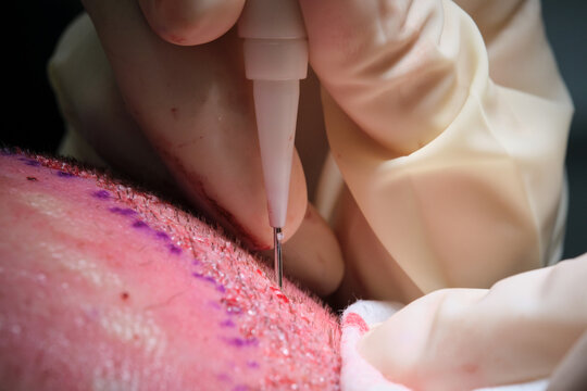 Hair transplant procedure close-up showing scalp and medical needle