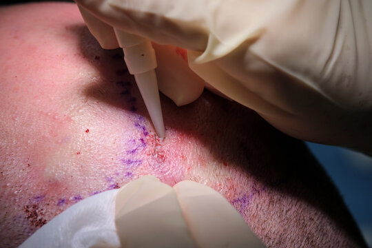 Close-up of a hair transplant procedure in progress