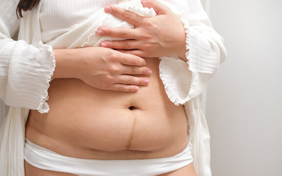 Scar on the abdomen after cesarean section