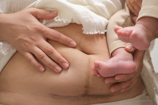 Scar on the abdomen after cesarean section.