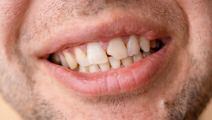 Close-up of a man's open smile with a broken tooth before a dentist appointment