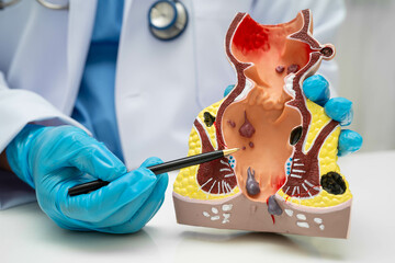 Asian doctor with rectum and hemorrhoid human anatomy model at hospital, inflamed vascular...