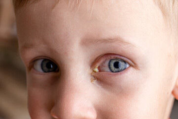 Conjunctivitis in the eyes of a child, pus and inflammation of the eyes of a baby boy close-up