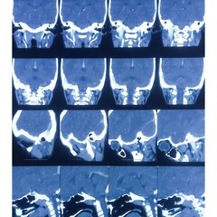 CT scan of the temporal bones showing soft tissue density lesion at bilateral middle ear and...