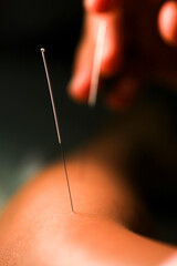 Acupuncture is a branch of alternative medicine that treats diseases.