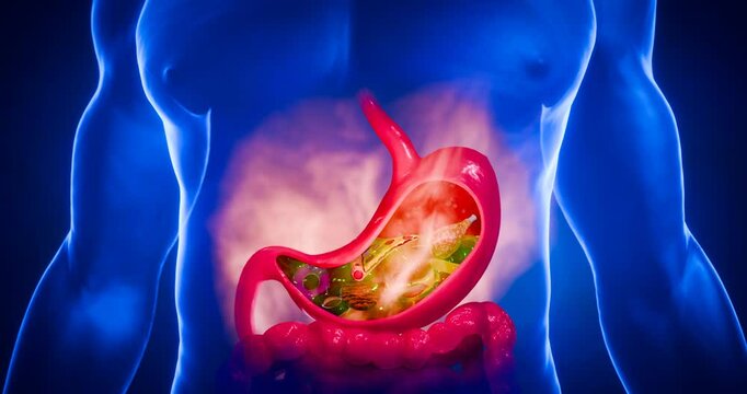 Symptoms of acid reflux or excess acid in the stomach. Gastric juice and intestinal model within the abdominal cavity. Burning sensation in the middle of the chest, acid reflux. 3D Rendering