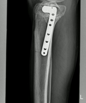 Tibial Plateau Fracture Fixation X-Ray