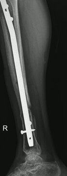 Tibial IM Nail X-Ray Imaging