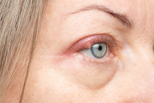 Bacterial infection stye on upper eyelid with purulent bump on eye of woman.