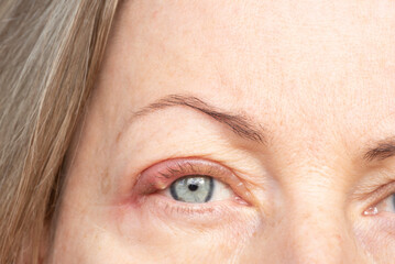 Purulent lump, compaction. Barley on the eye between the eyelashes of a woman.