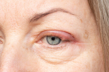 Treatment of inflammation of purulent barley (chalazion) on the eye of a woman.