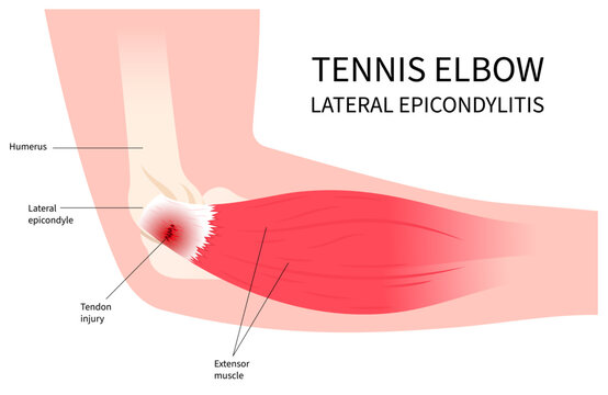 Anatomy of Lateral epicondylitis or called Golfer&rsquo;s tennis elbow with arm tendon and muscle inflammation pain