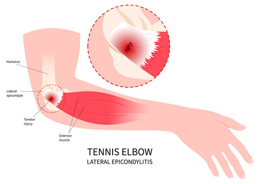 Muscle anatomy of Lateral epicondylitis or called Golfer&rsquo;s tennis elbow with arm tendon inflammation pain