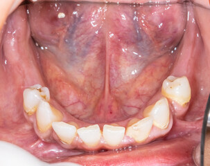 Front view close-up of a prosthodontic dentistry case. The mouth of a partially edentulous patient is open, showing missing molars and a retracted tongue.