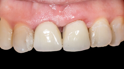 Frontal view of maxillary arch incisors and canines teeth and fixed prosthetic dental crowns in central incisors. Unaesthetic restorations isolated on a back background with photography contraster.