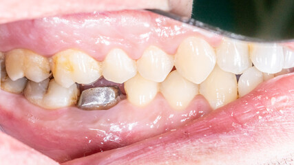 Lateral view of dental arches in occlusion with a lower molar decayed and destroyed crown, restored with a prosthodontic metallic post and core build-up. Lateral mirror indirect view 