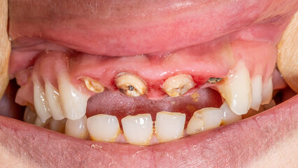 Front view of decayed incisors, roots and inflammatory bleeding gingiva gum in dental occlusion. Cheeks and lips retracted with wooden tongue depressors. Posterior maxilla removable partial prosthesis