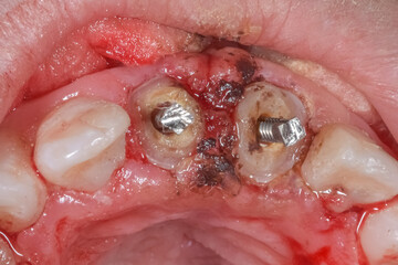 Gingival condition hyperplasia disease bleeding gum tumefaction abscess gingivitis and central incisors with dental decay, Screw posts sealed on completely destroyed anterior teeth enamel crowns. 