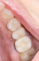 Part of the upper maxillary jaw with an aesthetic composite restoration on a premolar, an unaesthetic ceramic crown on a molar, and a decay on the last tooth. Close-up view of a dentistry patient case